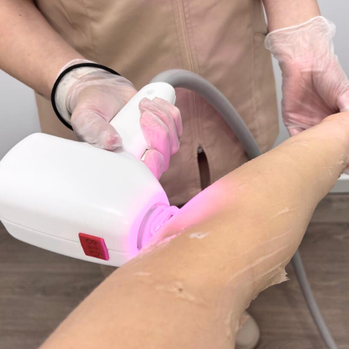 ¿Duele la depilación láser? Sensaciones reales y consejos